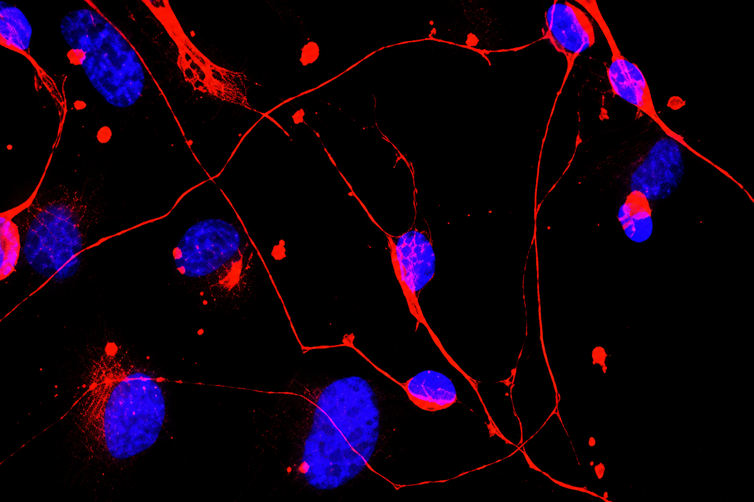 From VUS to pathogenic: functional evidence in PPP1R9A